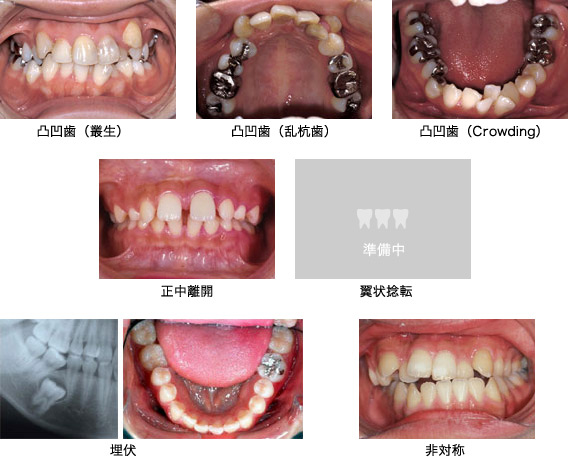 凸凹歯(叢生:そうせい、乱杭歯:らんぐいば、Crowdingと呼ばれる)、正中離開、翼状捻転、埋伏、非対称の写真